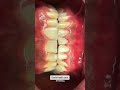 ‏The beast whiten teeth,Oral Healthcare,Treatment of periodontal disease