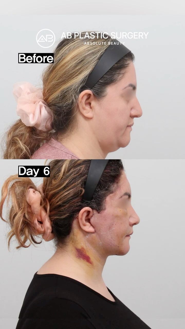 I Chose Korea for My Facelift... The Change Surprised Me
