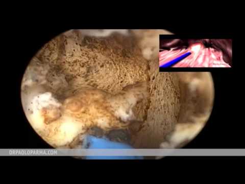 Trattamento palliativo del cancro alla prostata Video di esercizio ad un adenoma della prostata