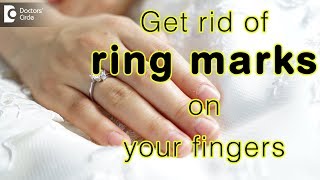 How to get rid of ring marks on your fingers? - Dr. Rajdeep Mysore
