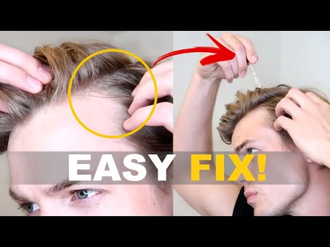 How To Tell If You're Going Bald (And How to STOP IT!)