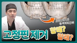 윤곽수술ㅣ고정핀 제거 할래? 말래?ㅣ비티성형외과