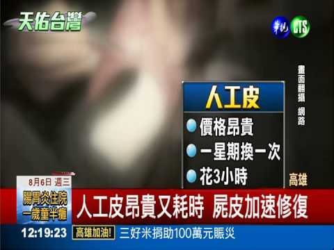 醫院鬧"皮"荒 49燒傷病患等著救