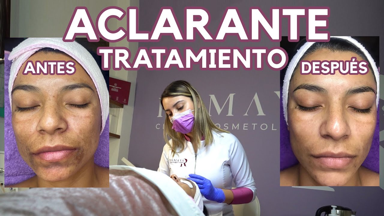 Watch CÓMO QUITAR LAS MANCHAS | TRATAMIENTO - Ximena Ramana Now CÓMO QUITAR LAS MANCHAS | TRATAMIENTO - Ximena Ramana