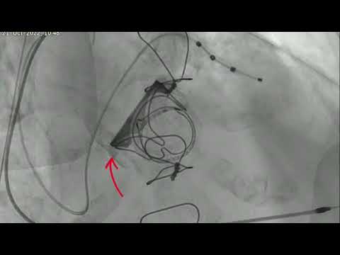 Dr Malik performs a Transcatheter Valve: MITRAL Valve-in-Valve TAVI shown at IVCC 2022