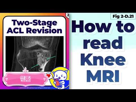 한글 (Fig 2-D.21) Two-Stage ACL Revision