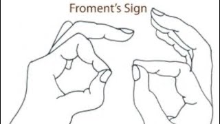 Dấu hiệu Froment