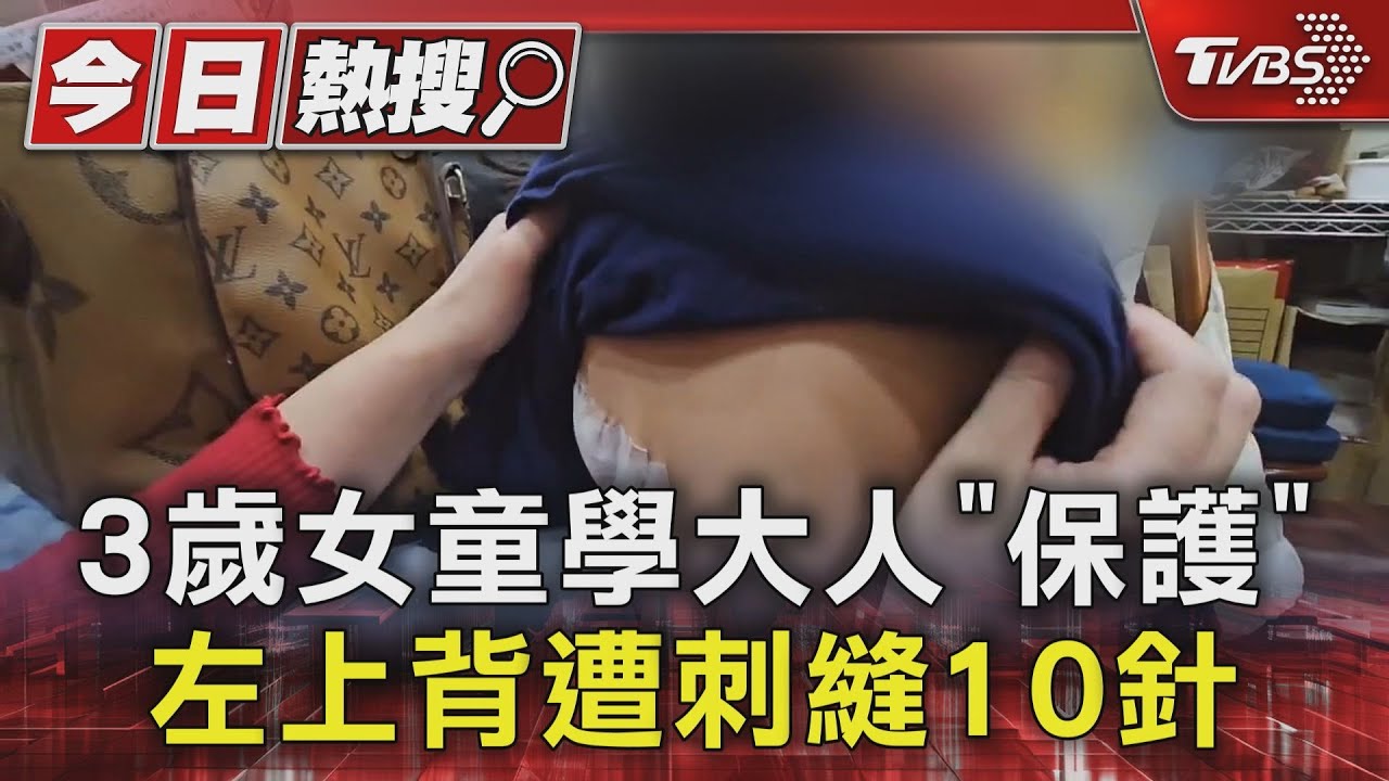 3歲女童學大人「保護」左上背遭刺縫10針