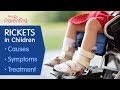 Rickets in Children  -  Causes, Symptoms and Treatment