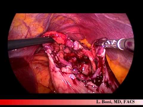 Resección laparoscópica de un gran tumor del estroma gastrointestinal (GIST) intraluminal utilizando instrumentos quirúrgicos percutáneos de 3 mm