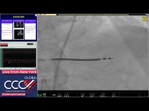LC #1 - IVUS guided LM PCI with Atherectomy - CCC 2019