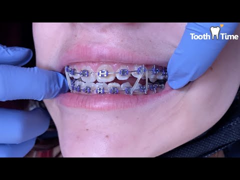 Braces Checkups - Rubber bands - Changing Wire - Tooth Time Family Dentistry New Braunfels