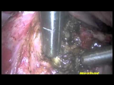Laparoscopic Excision of Bowel Endometrioma