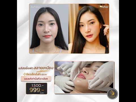 เมโสแฟตเหนียง