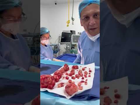 Retiro de mioma uterino Medellín - Dr. Juan Federico Zapata ginecólogo