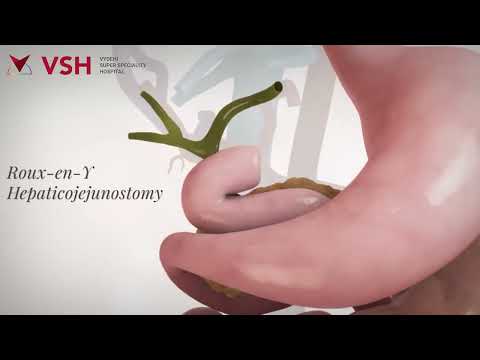 Patient Testimonial | Mr. Lava | Jaundice & Bile Duct Stones Treatment