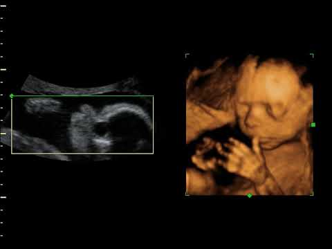 3D Ultrasound at 25 weeks from GoldenView Ultrasound
