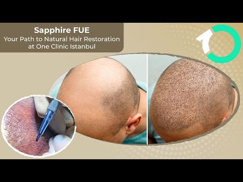 Sapphire FUE Hair Transplantation - Surgical Procedure - One Clinic Patient Review Video