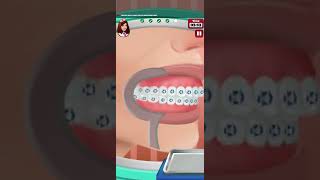 Download lagu Procedure for overbite correction ,surgery animation ASMR  |zuni tv| mp3