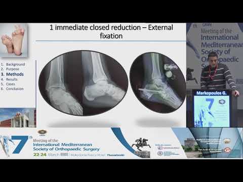 Markopoulos G - Peritalar dislocation: mid-term clinical, radiological and pedografic results