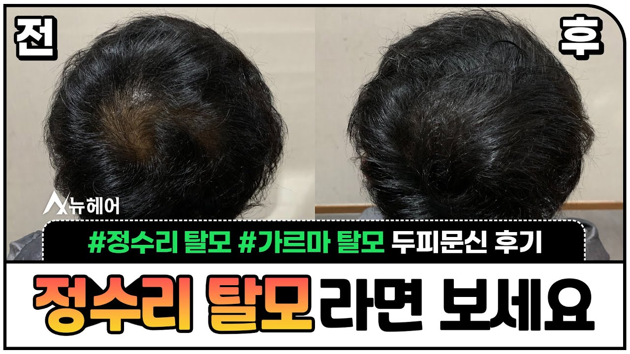 遮盖头顶脱发！ 纹头 不后悔纹头皮的方法 I New Hair