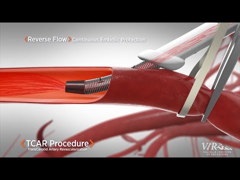 Vascular Institute of the Rockies is Pleased to Offer TCAR