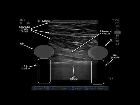 Ultrasound of Pneumothorax