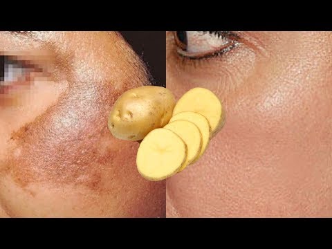 image-Is potato good for blemishes?