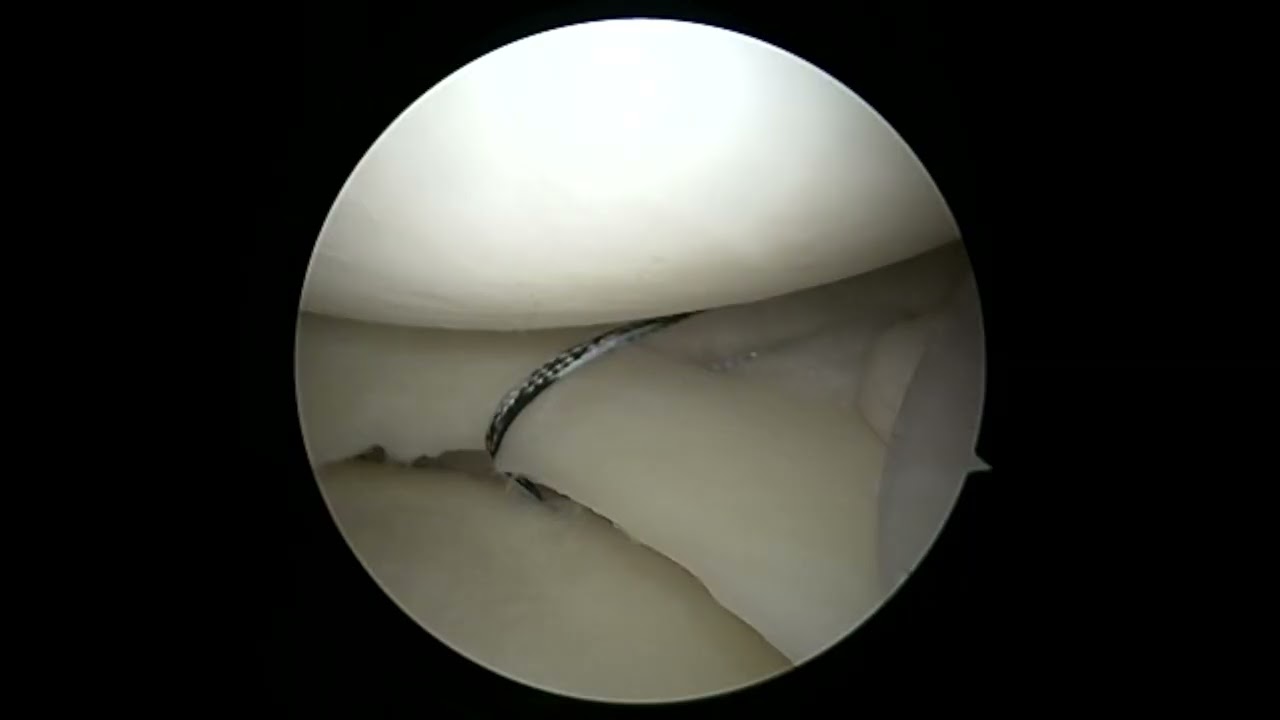 Updated Meniscal Root Repair with Centralization Stitch