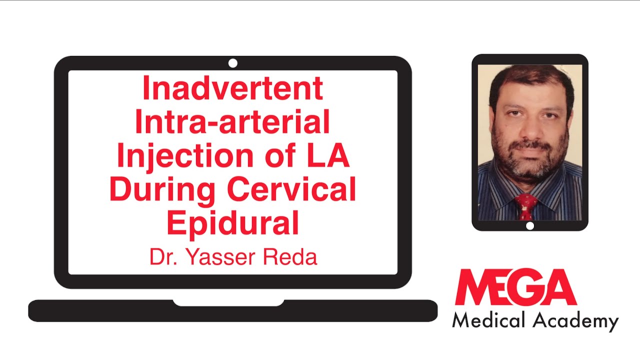 Inadvertent Intra arterial Injection of LA During Cervical Epidural
