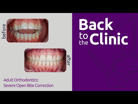 Adult Orthodontics: Severe Open Bite Correction - Back to the Clinic #008