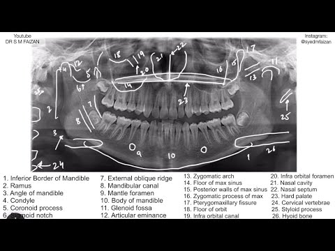 How to Read an OPG - (All Landmarks)
