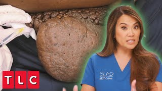 Dr. Lee Examines James&#39; &quot;Eye-Popping Bumps!&quot; | Dr. Pimple Popper