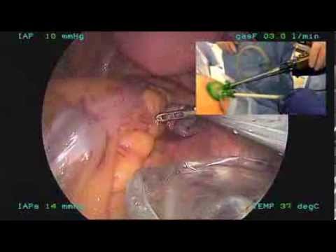 Obustronne laparoskopowe usunięcie jajników oraz jajowodów przez pojedyńczy port.