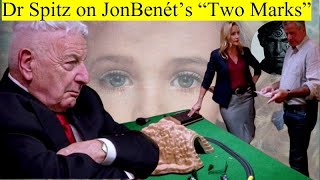 Do You Remember Dr Spitz's Shocking Theory on JonBenet's Twin Marks?