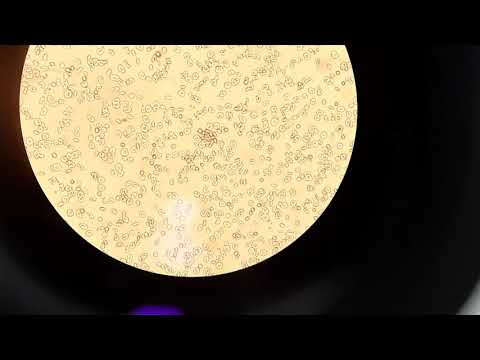 Blood compatibility testing shows a Compatible major cross-match results under microscopic!!