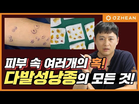 내 피부의 여러개의 혹. 다발성 낭종 (피지낭종, 표피낭종, 지방종, 털낭종, 종기)