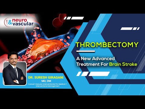 Thrombectomy: New Advanced Treatment for Major Brain Strokes | Dr. Suresh Giragani