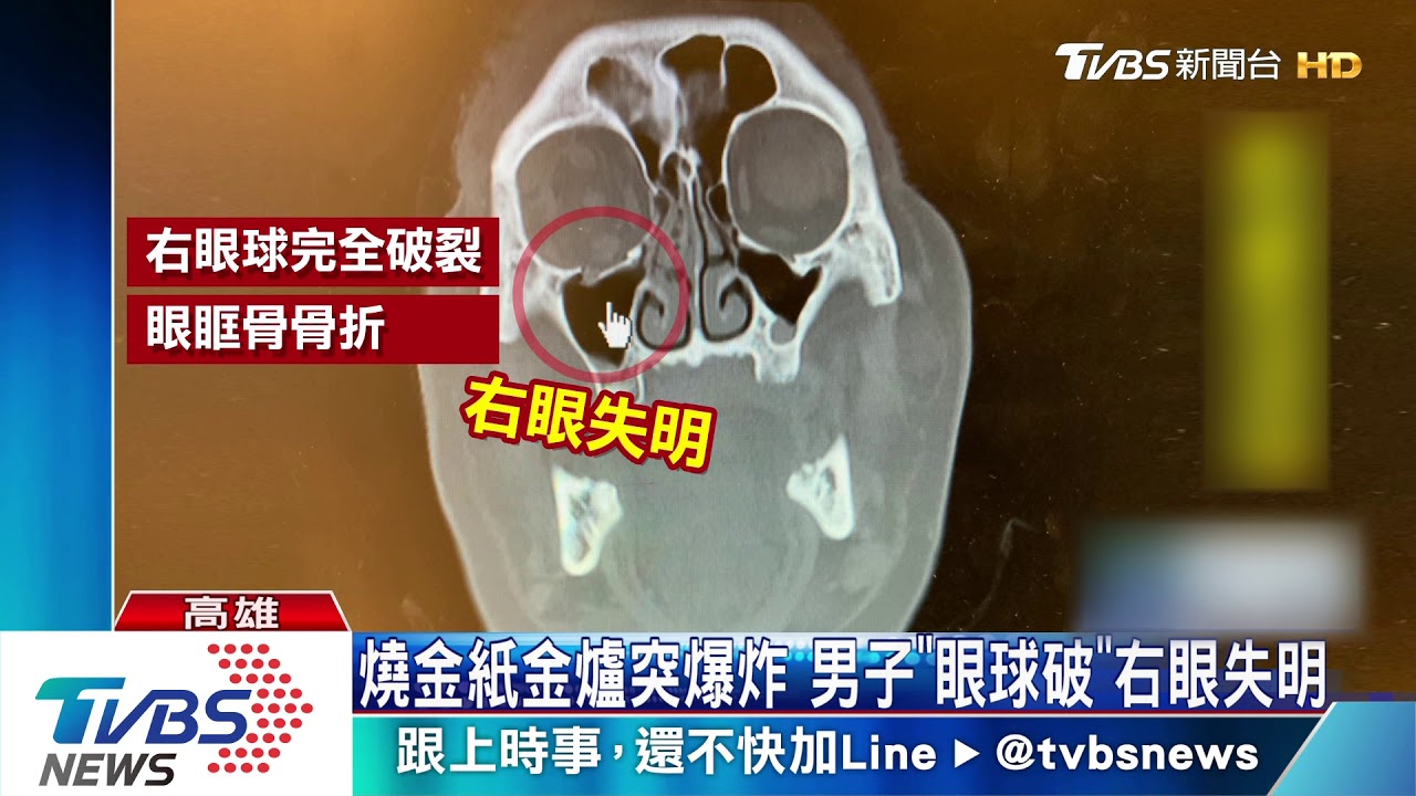 燒金紙金爐突爆炸 男子「眼球破」右眼失明