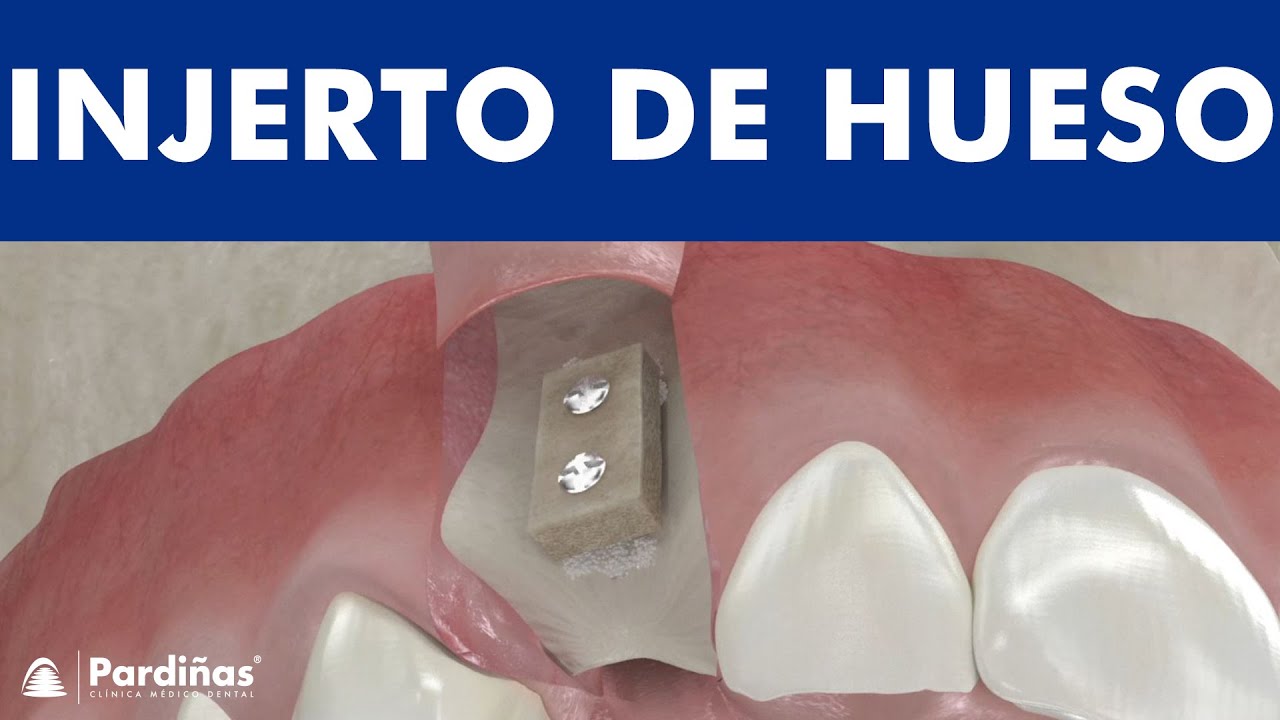 Watch Injerto de hueso en bloque © Now Injerto de hueso en bloque ©