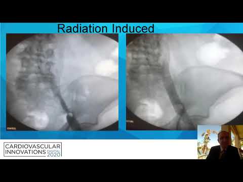 Interventions in Acute Deep Vein Thrombosis_Sharifi_Peripheral On Demand