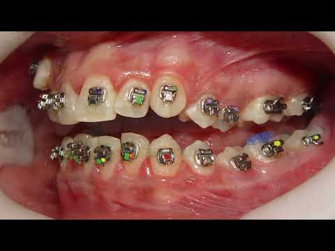 Solving severe dental Crowding with the Damon System