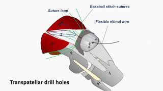 VY plasty for failed #quadriceps #tendon repair- short version