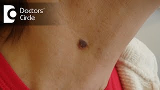 How to get rid of moles on neck? - Dr. Rasya Dixit