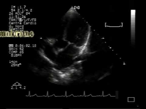 Subaortic Membrane And Ventricular Septal Defect (2/2)