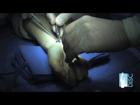 Operacja cieśni nadgarstka metodą endoskopową