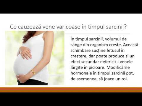 unguent cu vene varicoase în timpul sarcinii)