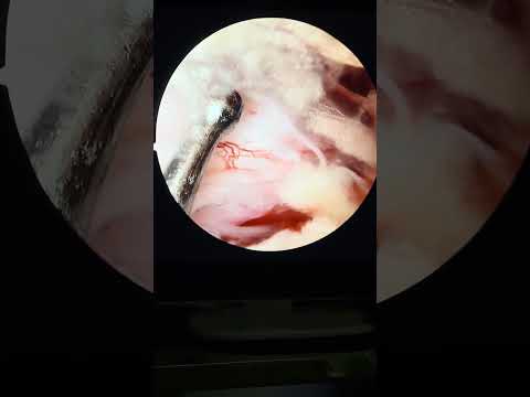 Endoscopic spine surgery : small incision , less blood loss , shorter hospital stay , fast recovery