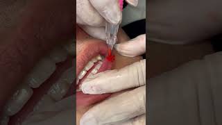 Download lagu Revitalização labial natural para homens 🤍✨ resultado de @wallacelara, pela Clinica Nilda Durães 😍 mp3