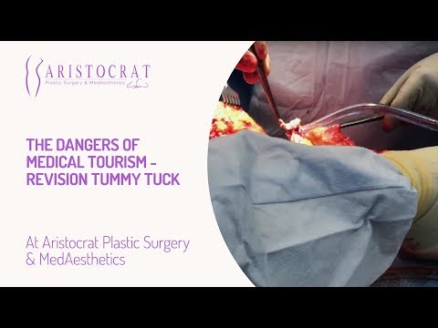 The Dangers of Medical Tourism- Revision Tummy Tuck